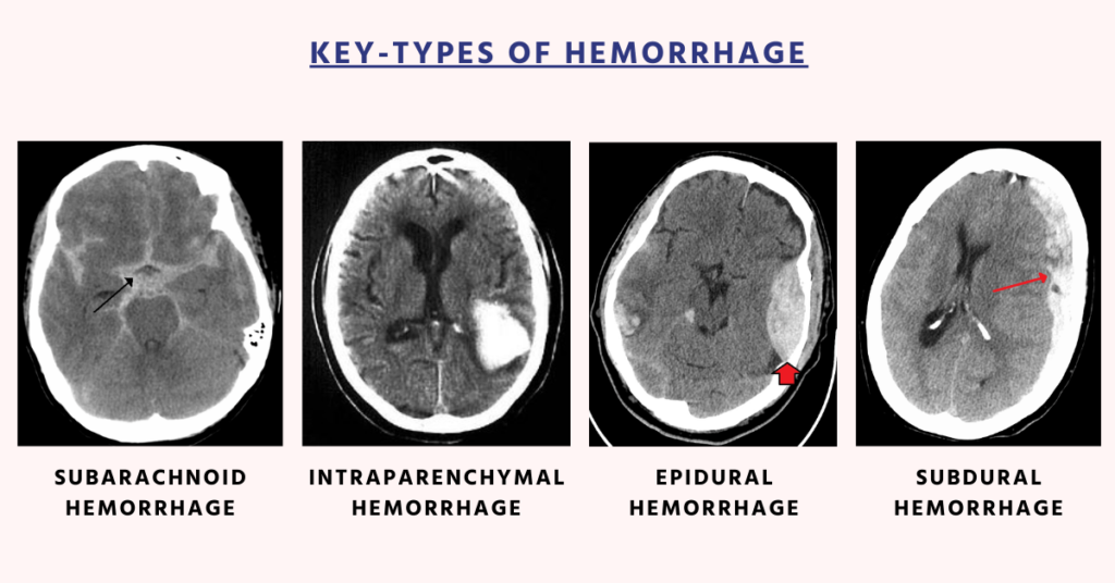 Key-Types of Hemorrhage